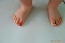 Wrastające paznokcie u małego dziecka.