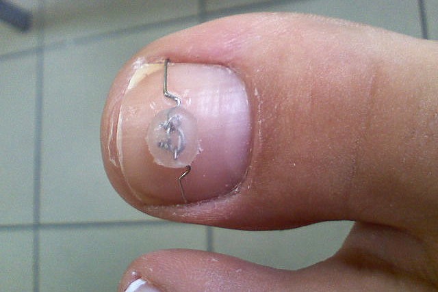 wrastające paznokcie klamra metalowa