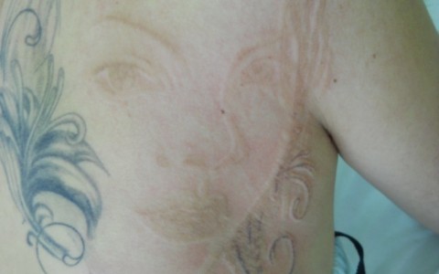 Laserowe usuwanie tatuażu