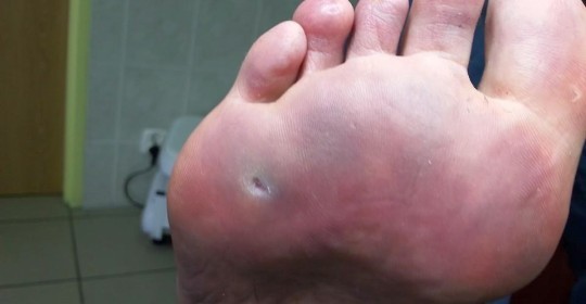 Usunięcie odcisku na przodostopiu